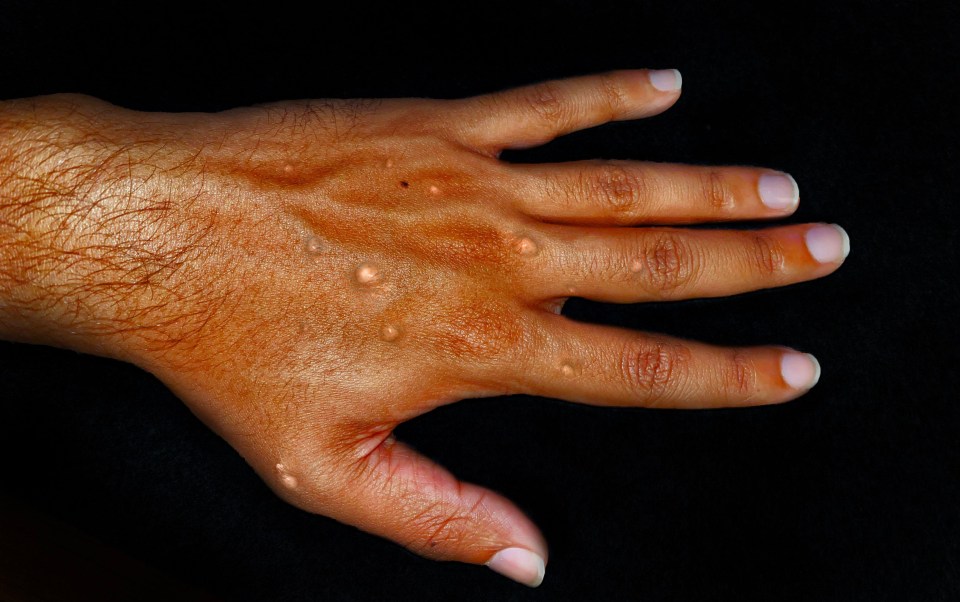 The disease causes rashes to appear on the skin