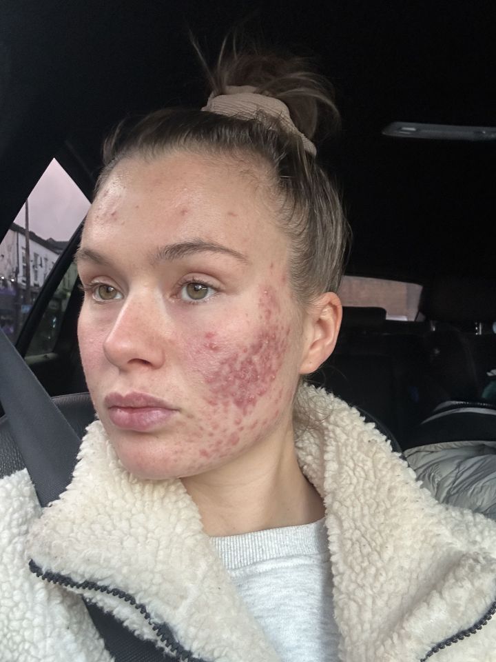 The stress from her addiction was giving her acne