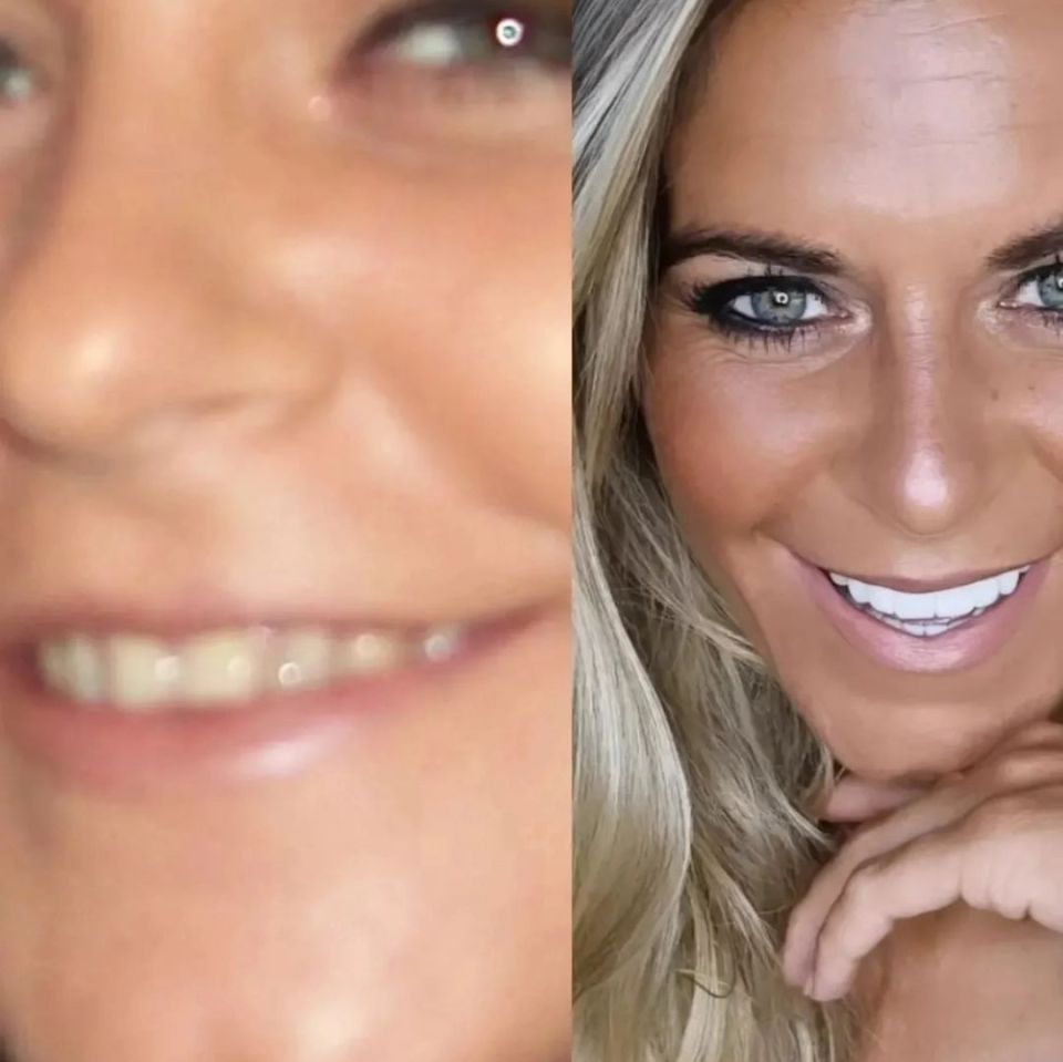 The actress showed off the before and after of her teeth