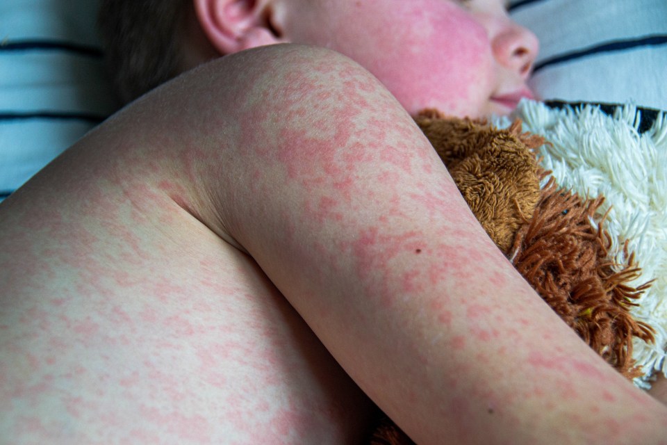 Europe saw a 200% increase in measles cases between 2022 and 2023