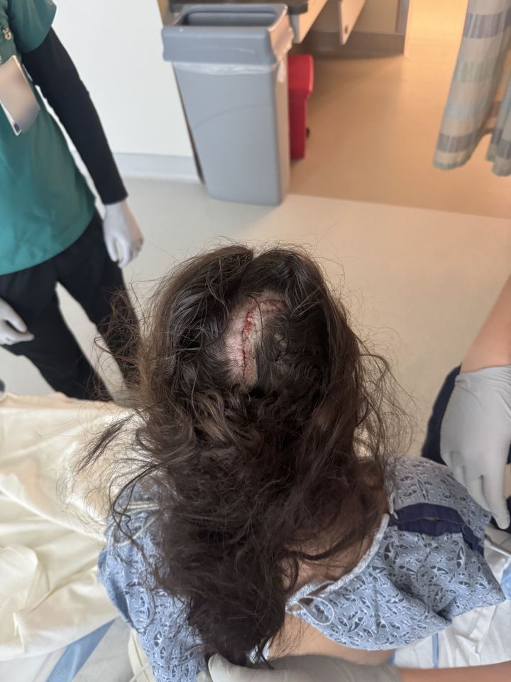 a woman laying in a hospital bed with a stitched hole in her head