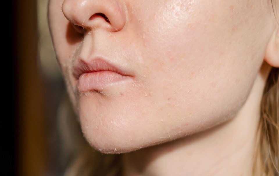 The woman skin flakes off at the mouth. Dry skin. Face skin irritation after peeling, after cold windy weather. Dark background, view by profile.