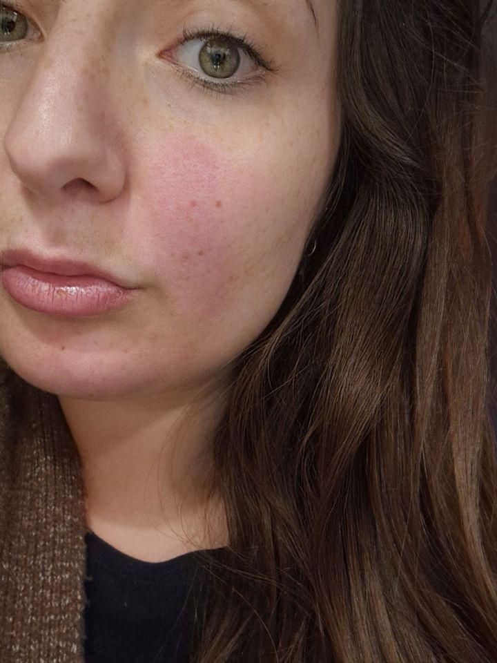 Close-up of a woman's face showing a rash.