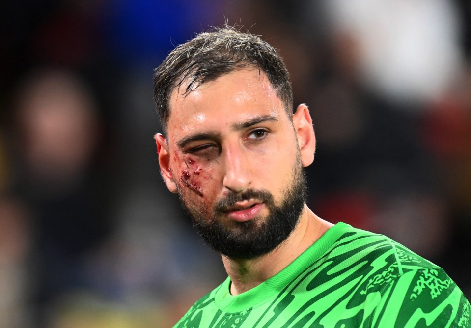 Gianluigi Donnarumma with a facial injury.