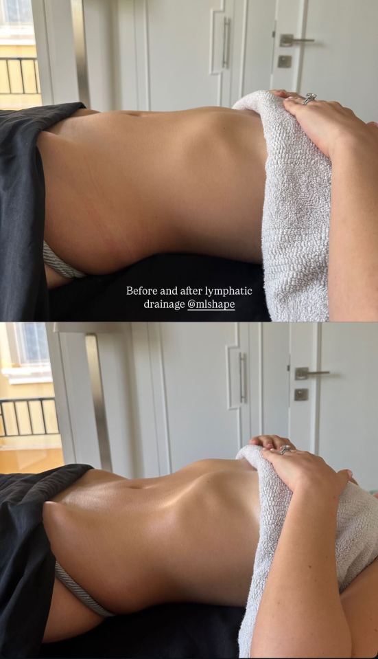 She revealed the results of the toning treatment in before and after snaps