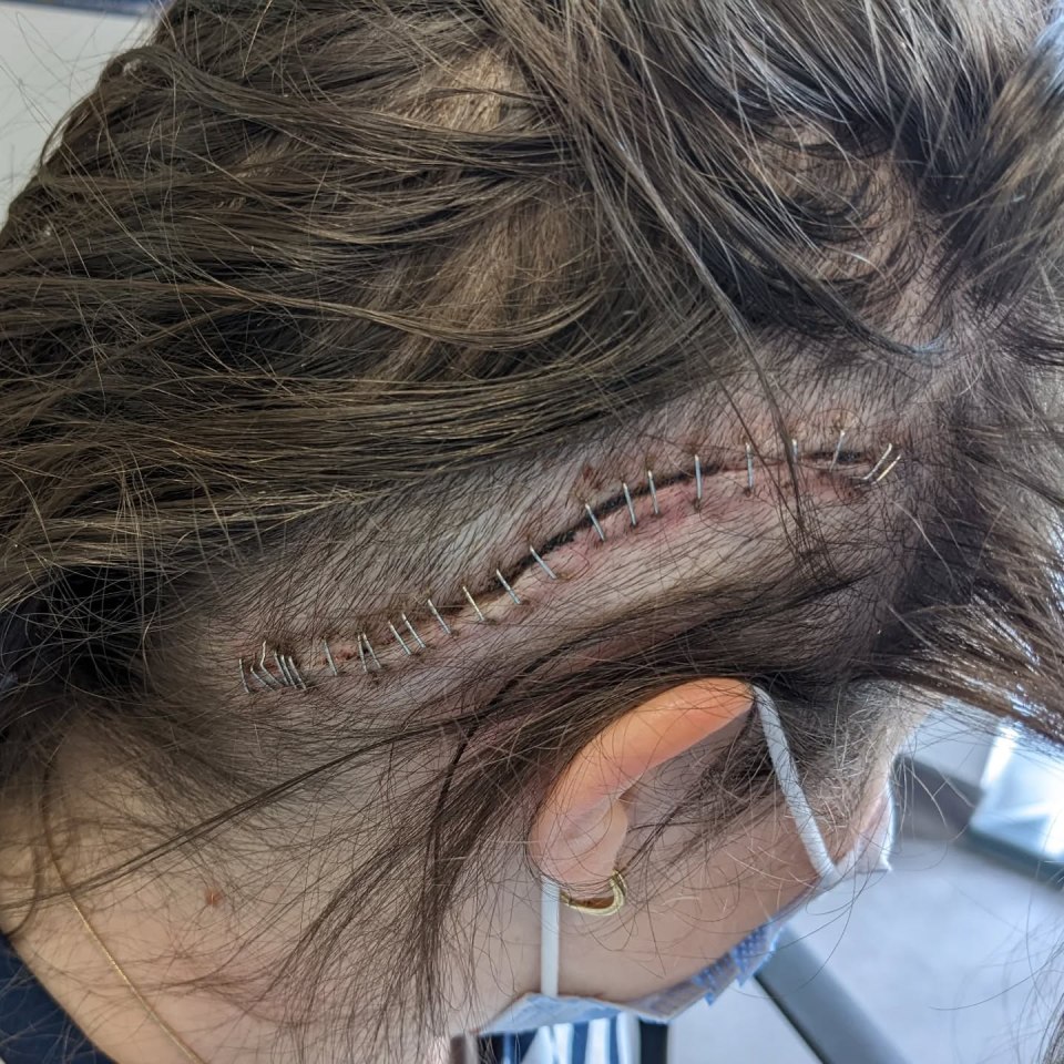 Theo Burrell has shared an image of her 'gruesome' brain scar amid her ongoing health battle