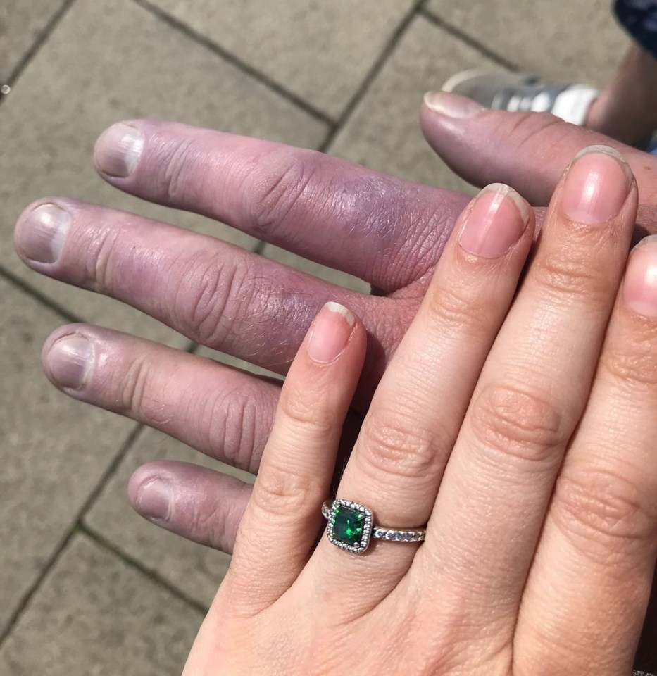 The dad first noticed strange sensations in his finger in 2017, recalling they went white after being in the cold