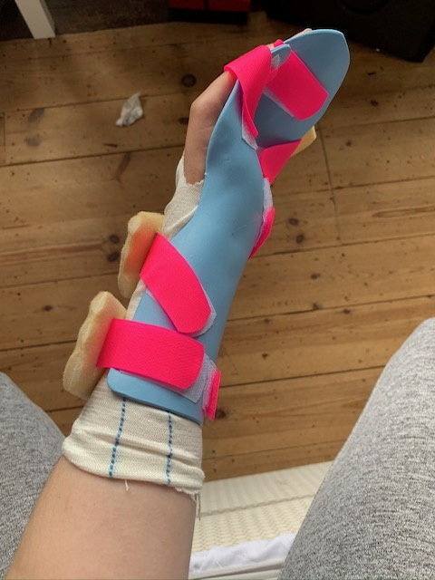 Woman's arm in a light blue cast with pink straps, following unsuccessful surgery to remove an embedded contraceptive implant.