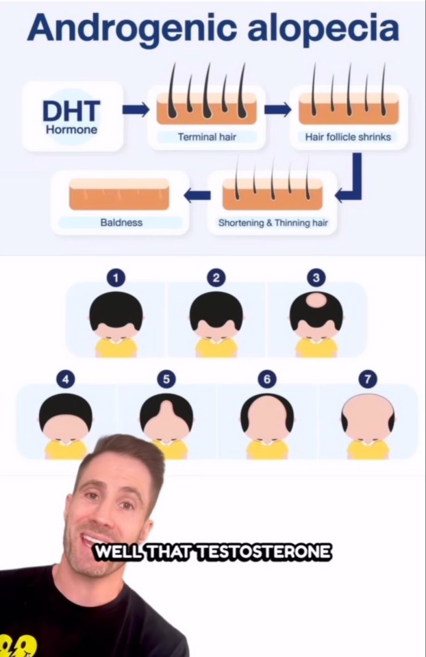 Diagram showing stages of androgenic alopecia and the role of DHT hormone.