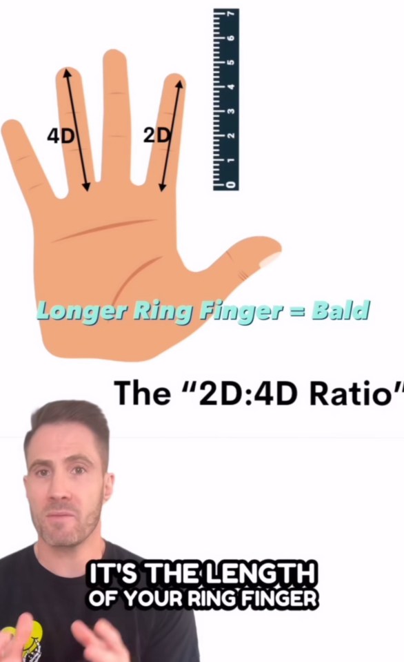 Diagram showing that a longer ring finger is linked to baldness, explained by the 2D:4D ratio.