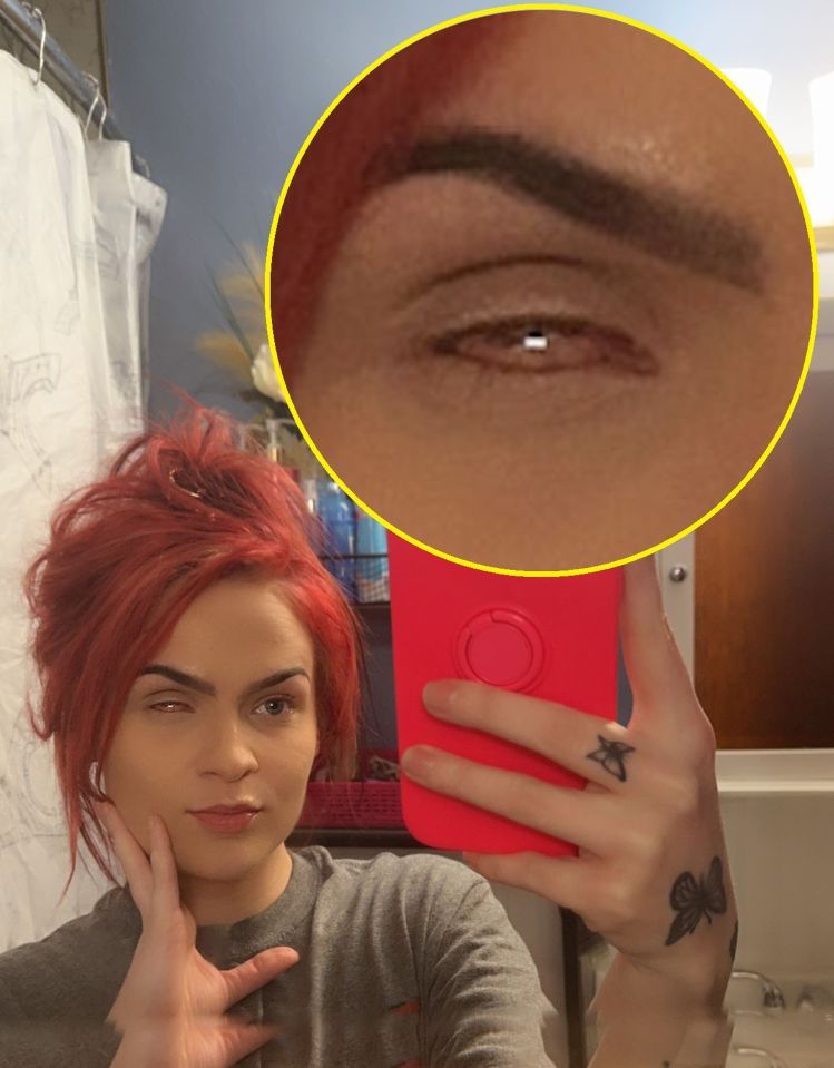 Kaitlyn Humphrey, 26, had to have her eyeball scooped out and replaced with a ‘marble’