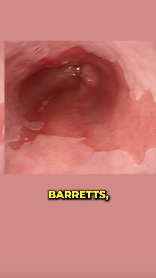 If acid reflux continued, over time, it can develop into Barrett's