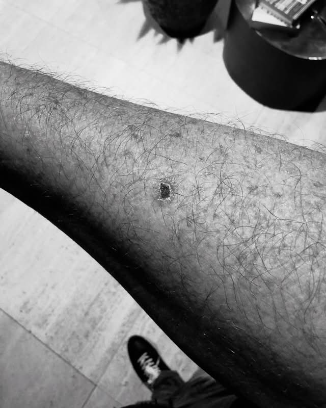 He said he found two moles on his shoulder and forearm, one of which was Melanoma