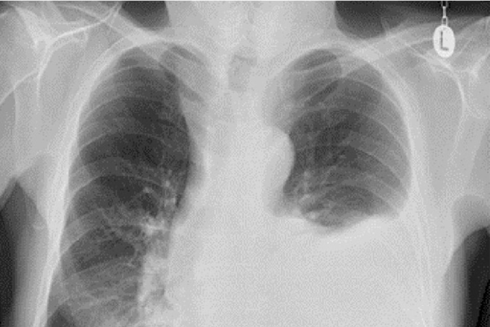 A chest X-ray revealed a large amount of milky fluid in the man’s lungs