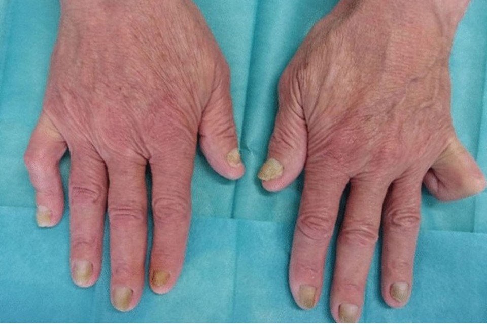 A man's yellowing nails were a sign of a tumour squishing his lungs and heart