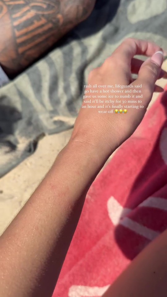 She showed off the itchy rash on her arm