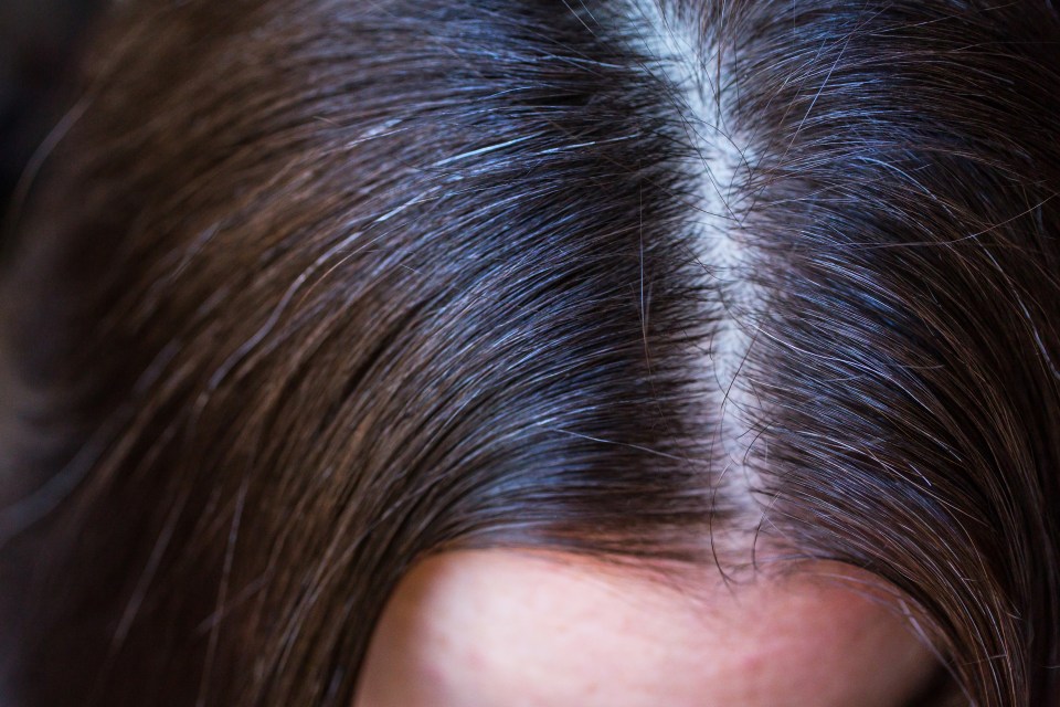 Close-up of a woman's scalp showing her first gray hairs.