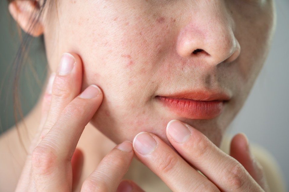 Close-up of a person's face showing wrinkles and blemishes.