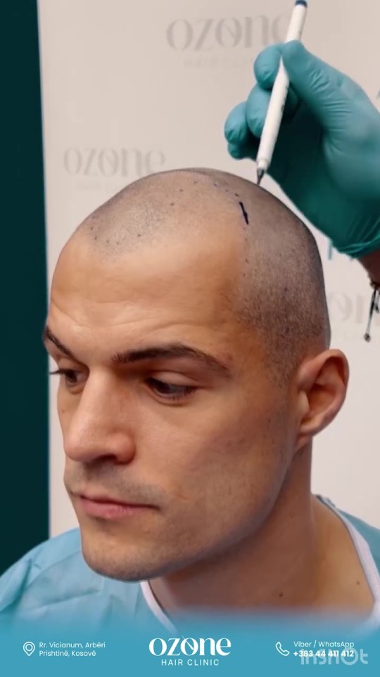 Granit Xhaka at Ozone Hair Clinic for a hair transplant.