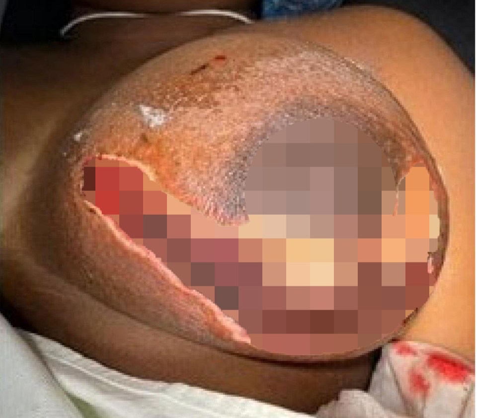 Graphic image of a woman's breast with necrotizing fasciitis.