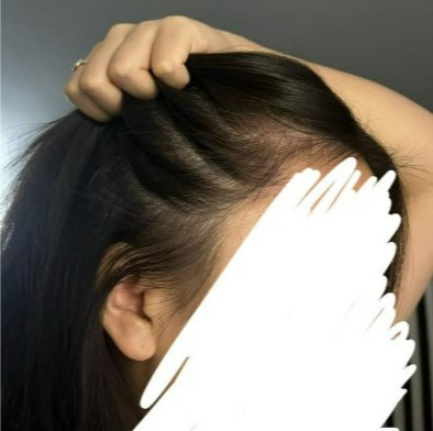 Hair showing signs of thinning.