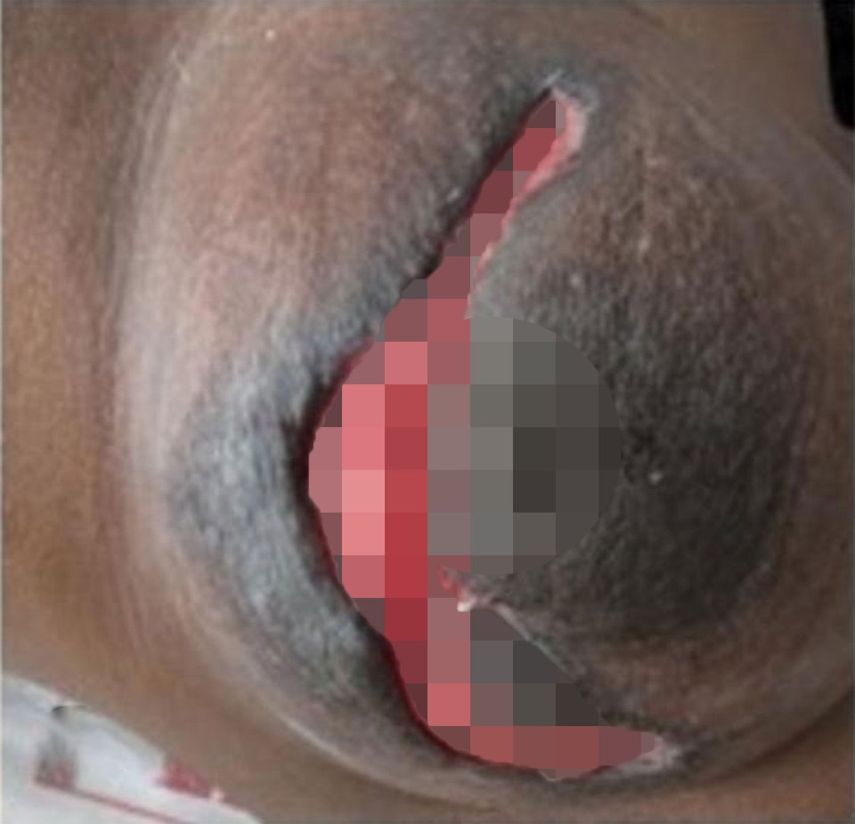 Close-up of a woman's breast with necrotizing fasciitis.