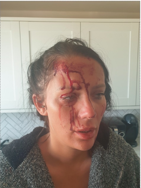 Woman with bloody face injuries.