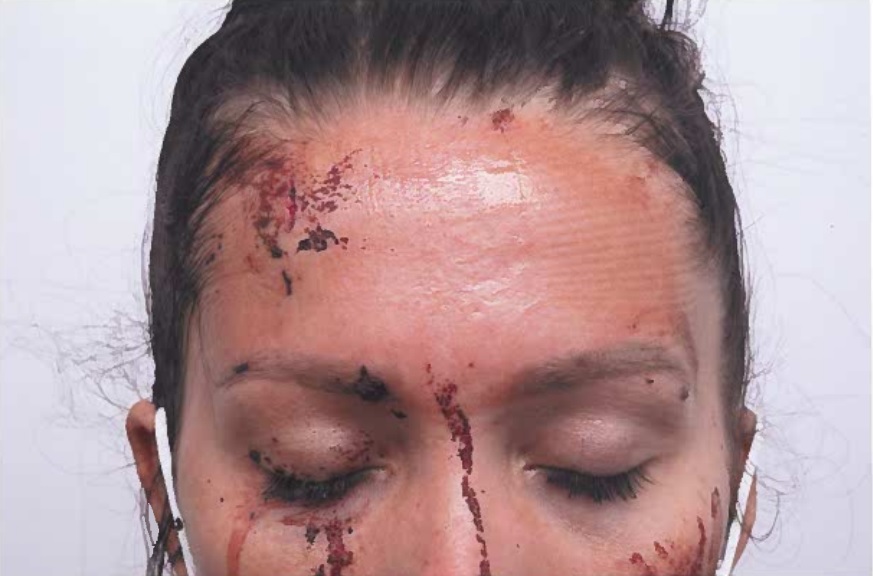 Close-up photo of a woman's face showing injuries from an assault.