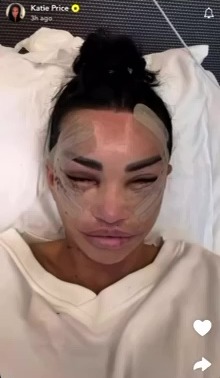 Katie Price's Snapchat selfie showing her face after surgery.