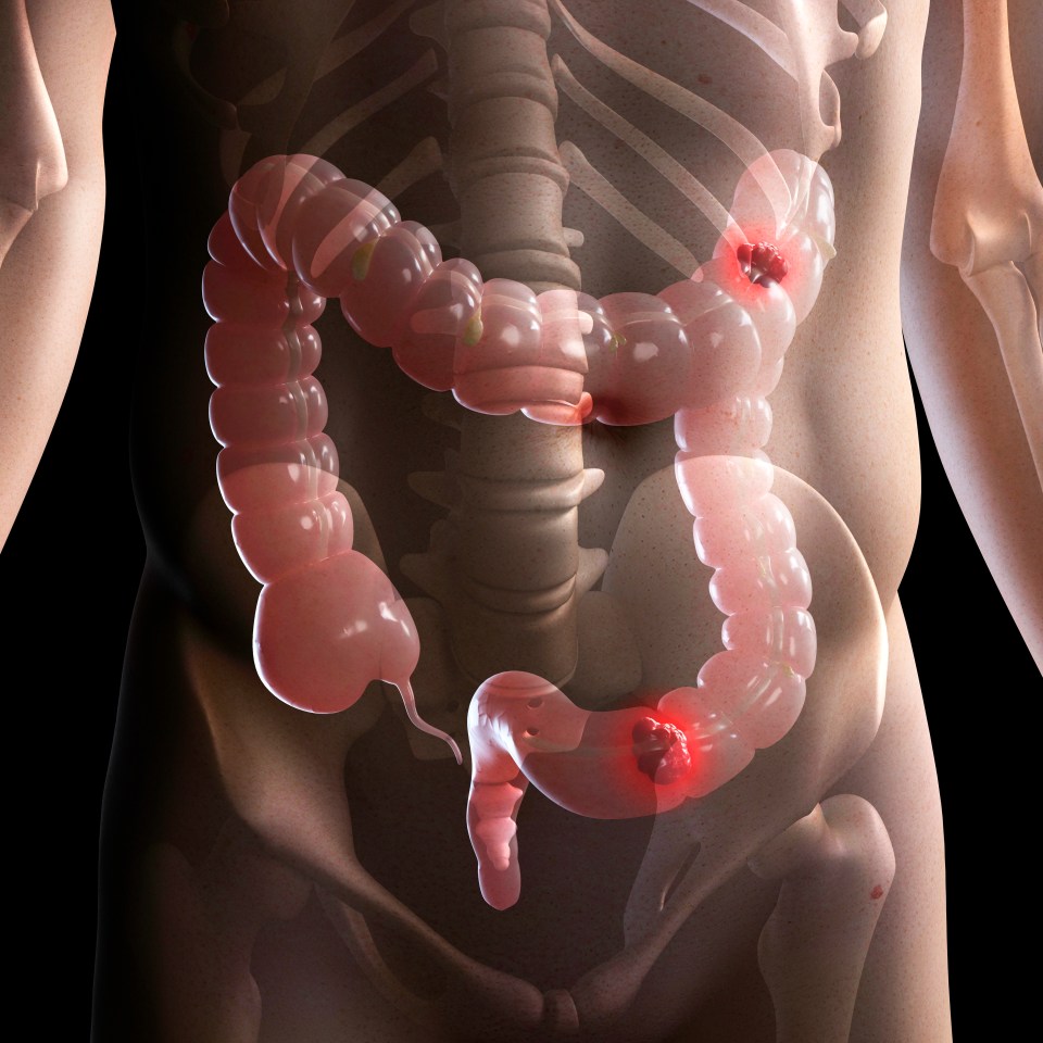 Illustration of bowel cancer tumors.