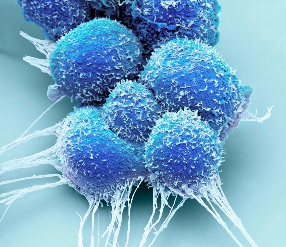 Coloured scanning electron micrograph (SEM) of prostate cancer cells forming a tumour.