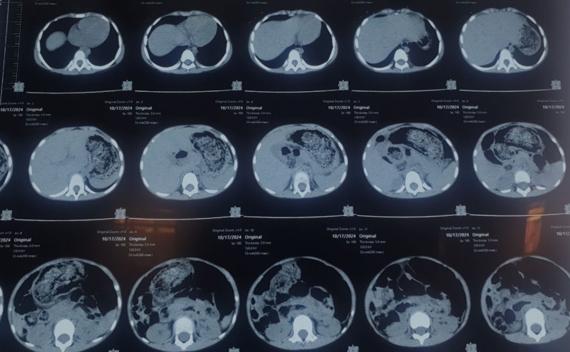 CT scan images showing a distended stomach containing a large bezoar.