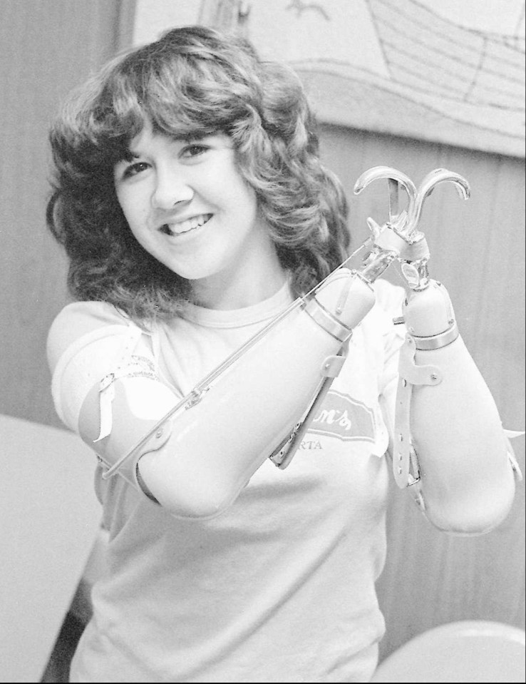 Black and white photo of Mary Vincent with prosthetic arms.