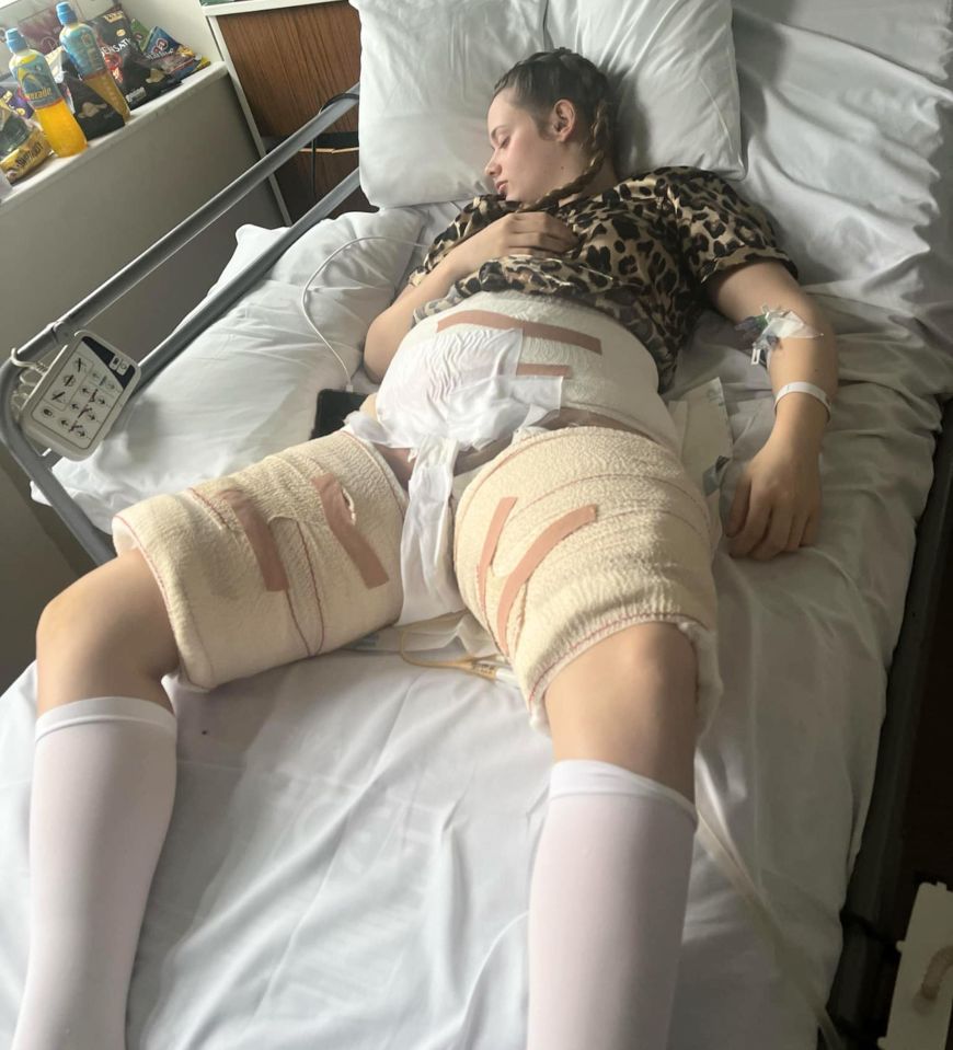 Teenage girl in hospital bed with bandages on her legs and stomach from hot water bottle burns.