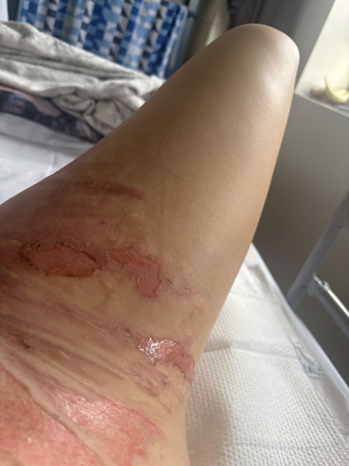 Severe burns on a person's leg.