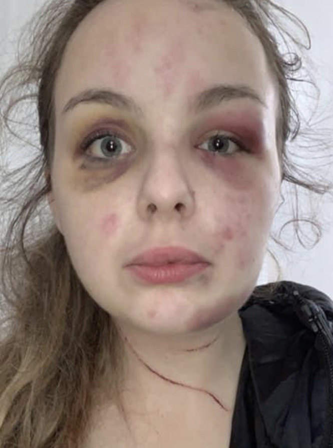 Fantasist Eleanor Williams injured herself with a hammer and posted pictures of her injuries on social media, blaming a grooming gang of Asian men