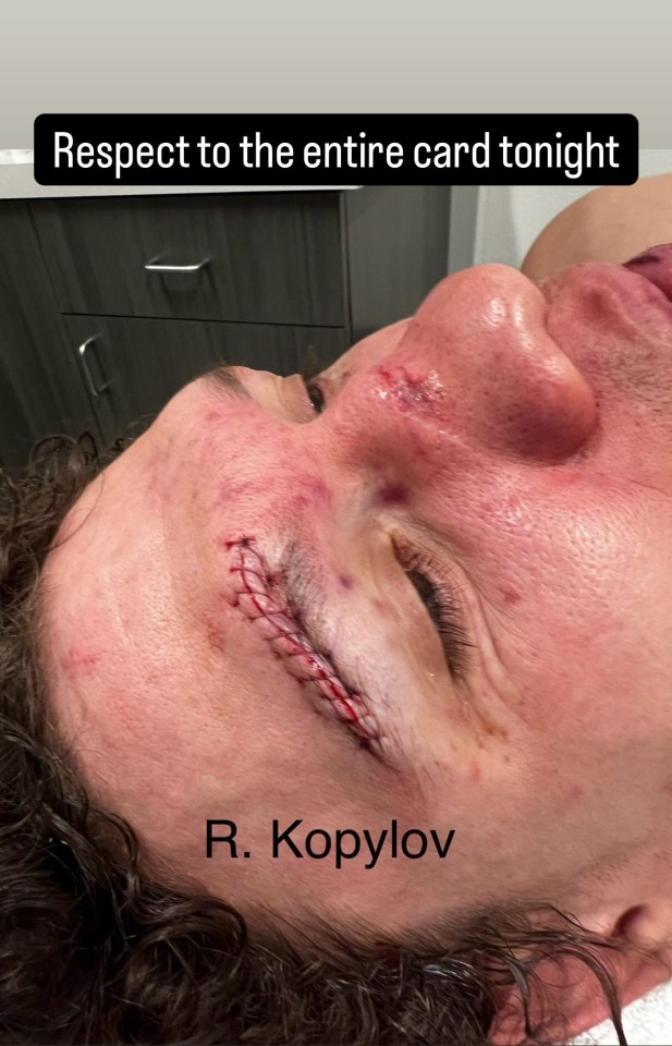 Close-up of R. Kopylov's stitched eyebrow and facial injuries.