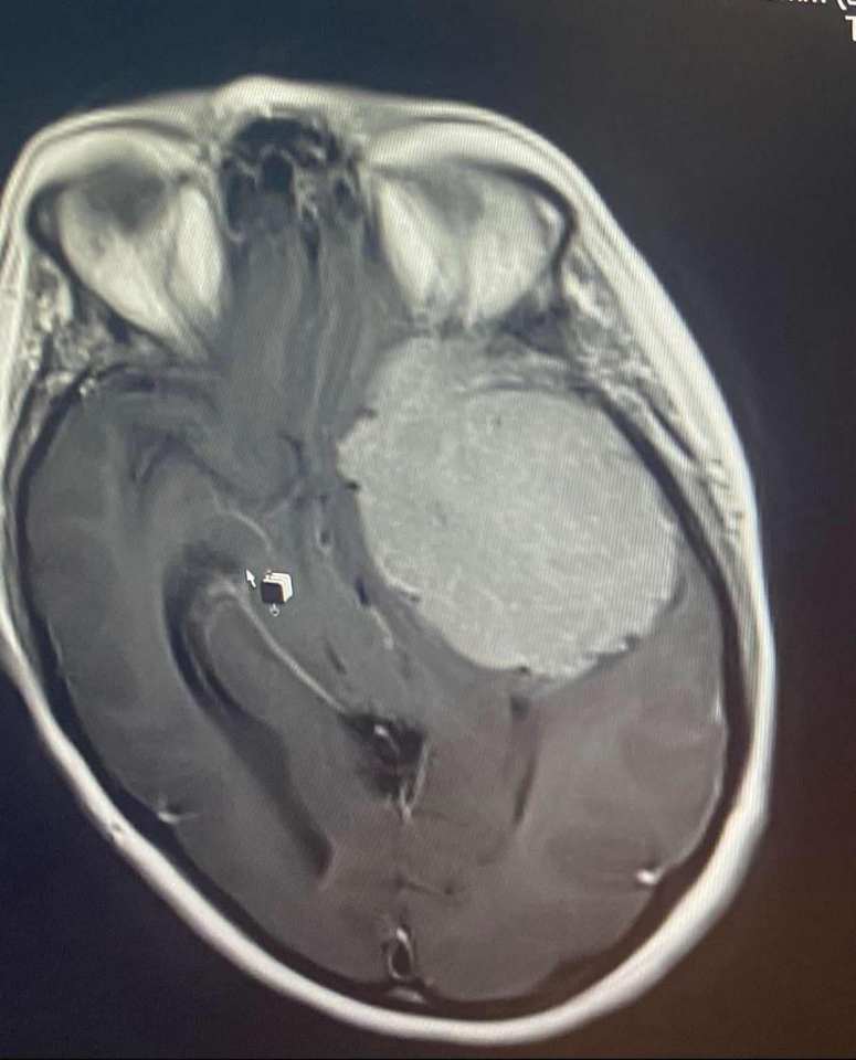 MRI scan of a brain tumor.