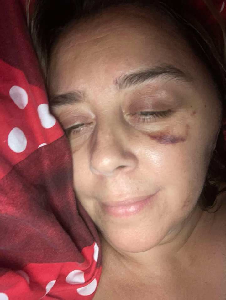 Close-up of a woman's face showing post-operative swelling and bruising.