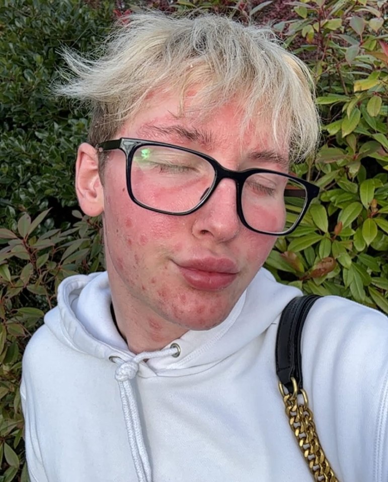 Person with psoriasis after lip fillers.