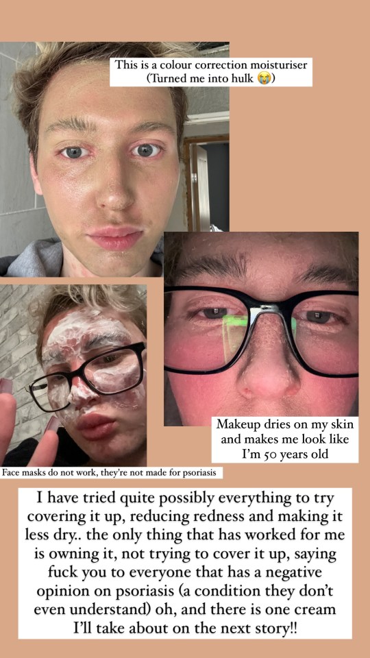 Collage of photos showing a person's experience with psoriasis before and after using makeup and other treatments.