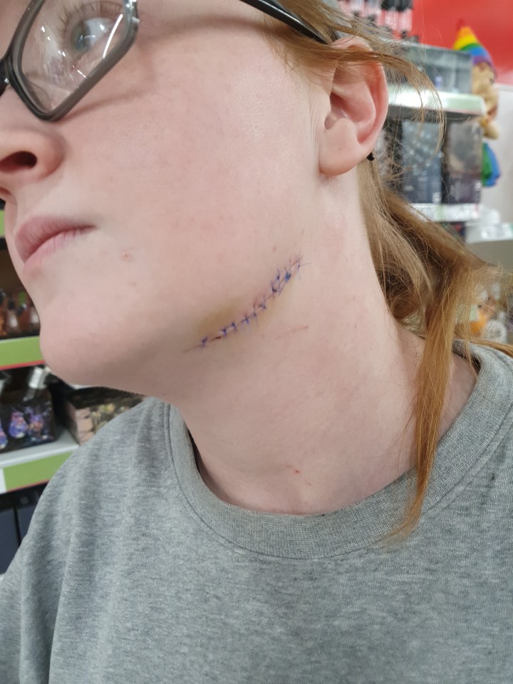 Neck wound with stitches.