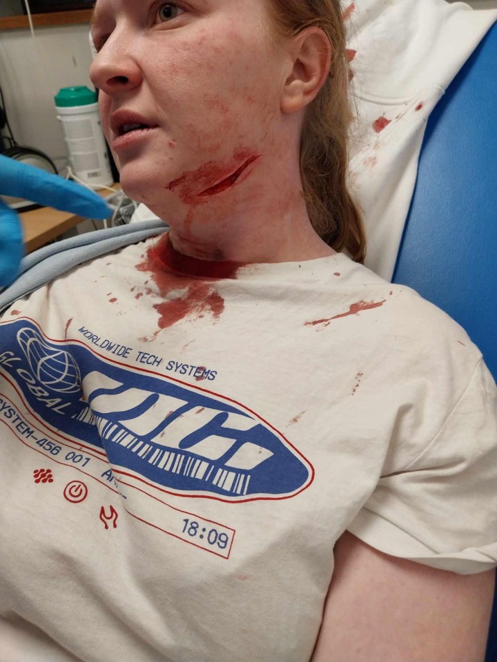 Woman's neck wound from a beer bottle attack.