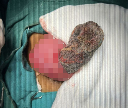 Intraoperative image of a large hairball removed from a child's stomach.