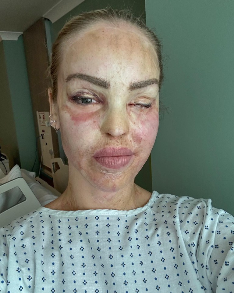 Katie Piper in a hospital gown after eye surgery.