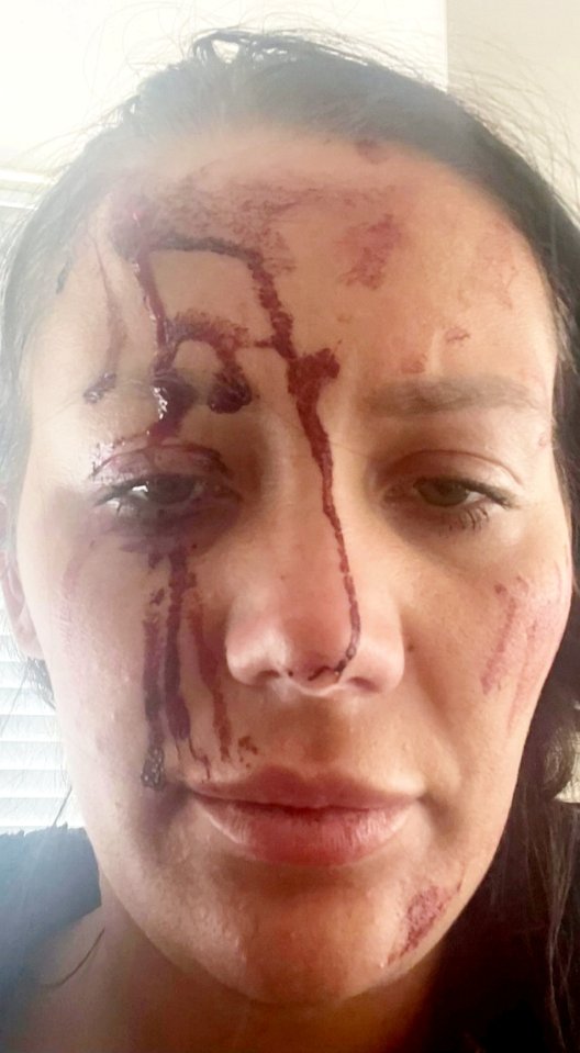 Close-up photo of a woman's face with blood and bruises.