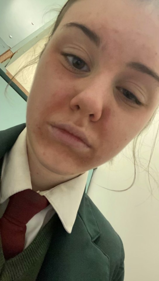 Teenage girl with severe facial blisters.