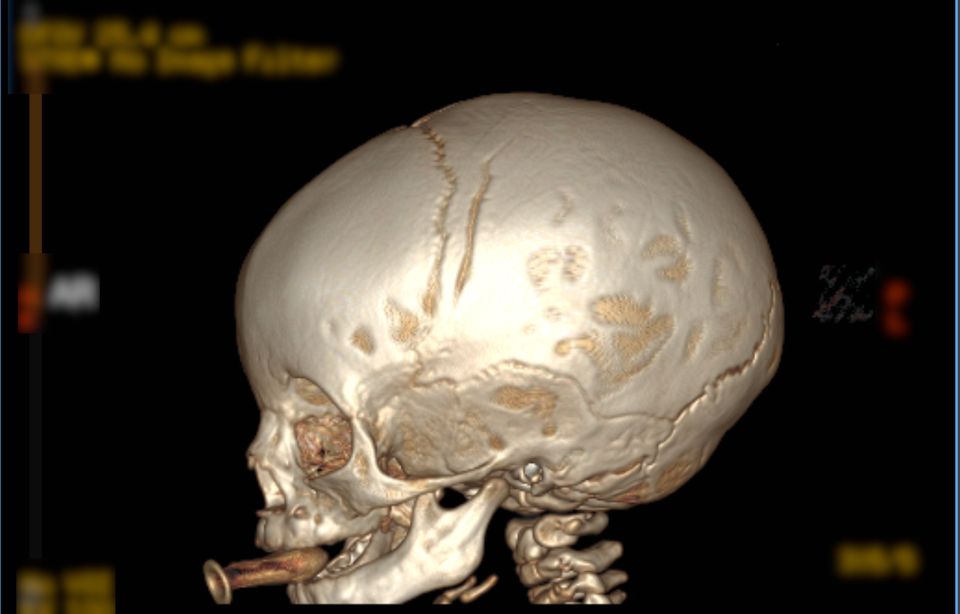 3D rendering of a baby's skull fracture.