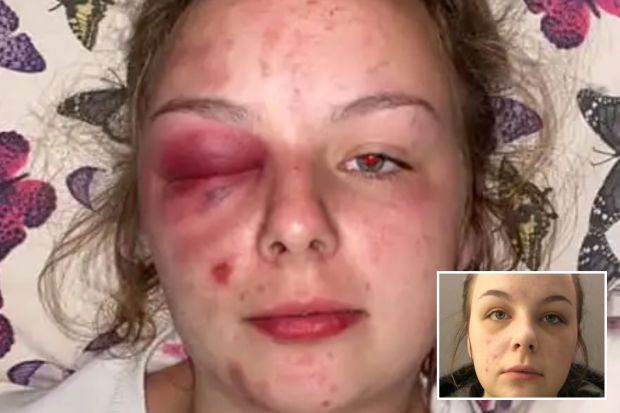 A young woman's face showing extensive bruising around her eye and other facial injuries, compared to an uninjured photo.