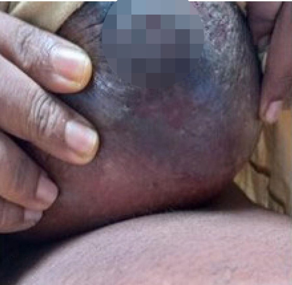 Postpartum breast with necrotizing fasciitis.